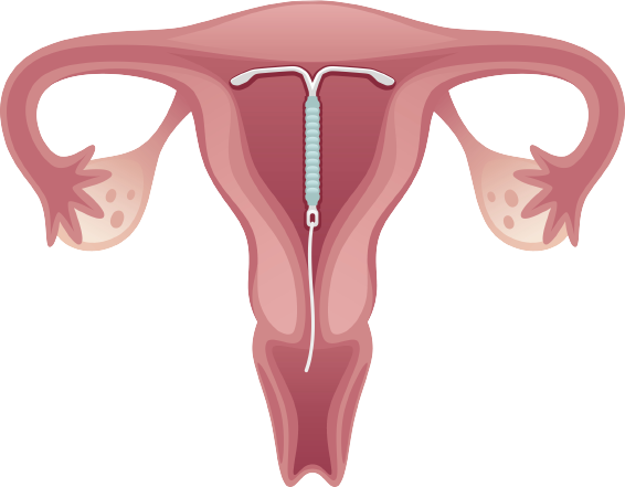 IUD Painful IUD Strings Hormonal IUD Perforated iud iud in uterus
